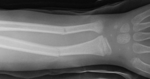 Eine Grünholzfraktur des linken Unterarmes in schwar-weißem Röngtenbild.