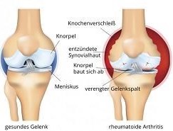 Nur selten verlaufen Verengungen des Gelenkspaltes symptomfrei. Oftmals geht die Verengung mit einer Entzündung der Synovialhaut einher.